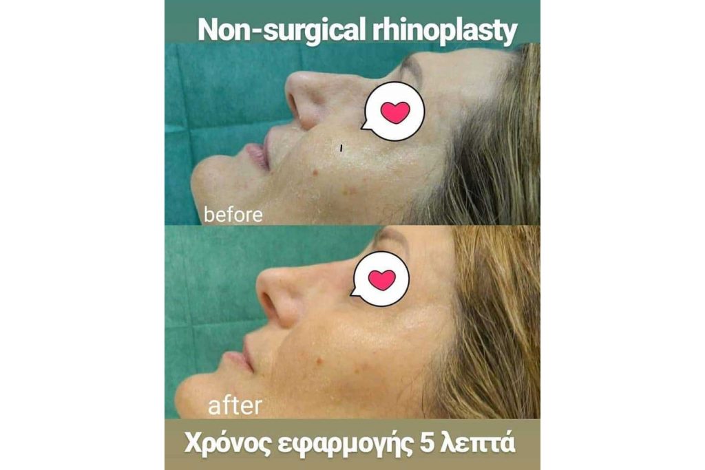 Αναίμακτη ρινοπλαστική σε 5 λεπτά γίνεται;