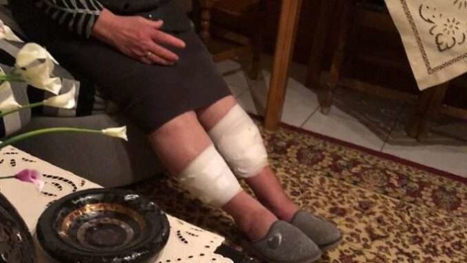 Τύρναβος: Σκύλος δάγκωσε 80χρονη